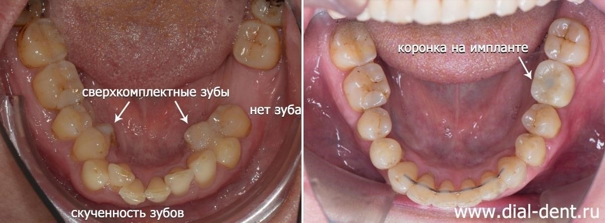 Соображения по поводу комплексного покрытия